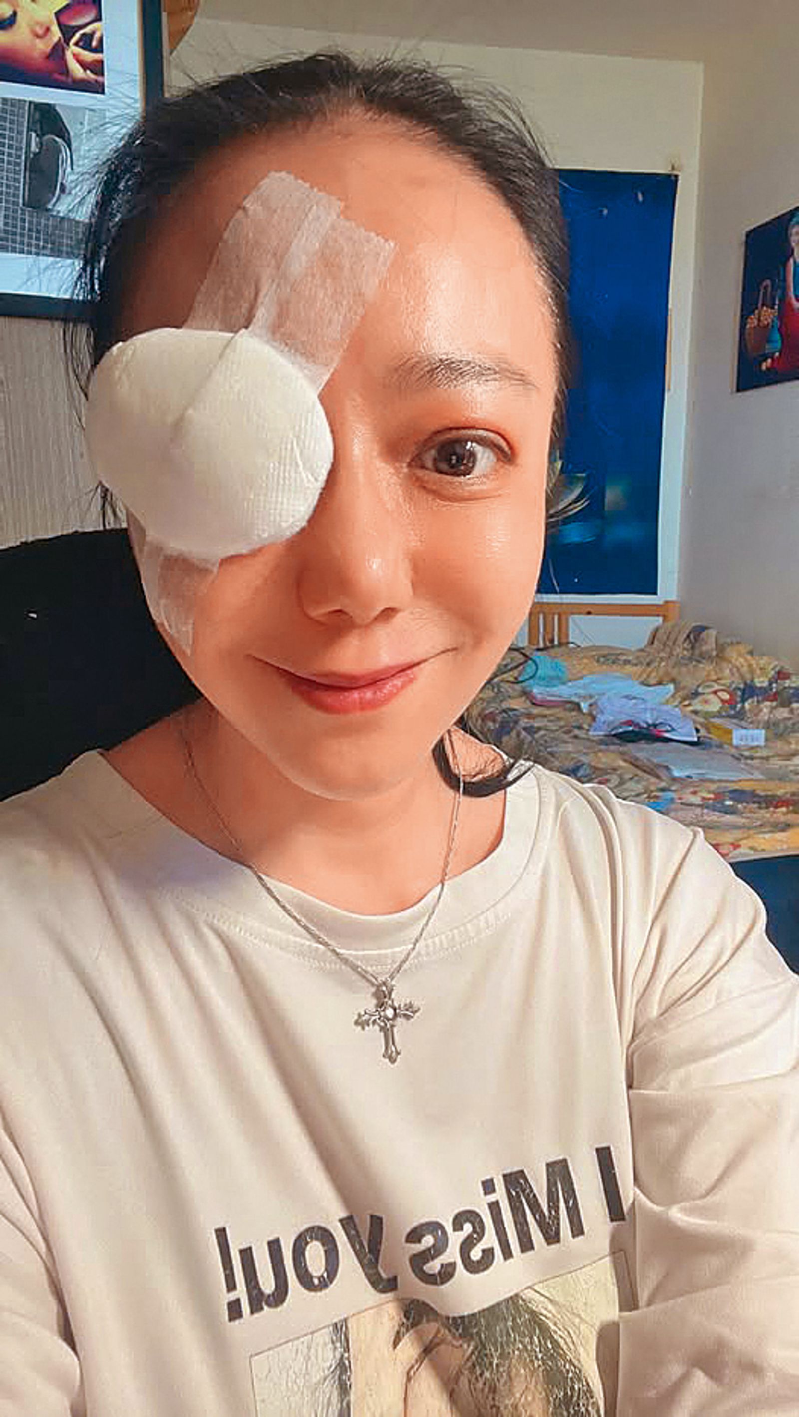 因甲狀腺低下引起斜視，高慧君戴了2年眼罩後才開始手術治療。（翻攝自高慧君臉書）