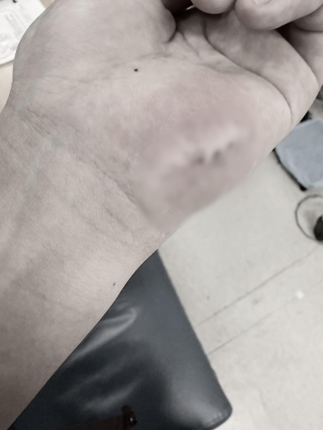 護理師遭病患惡意咬傷左手腕導致韌帶斷裂。（讀者提供；畫面經變色處理）