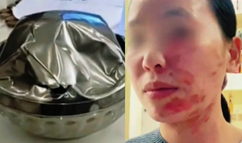 廚房隱形危機曝光!女子用錯碗裝熱油遭炸傷。(翻攝自抖音)