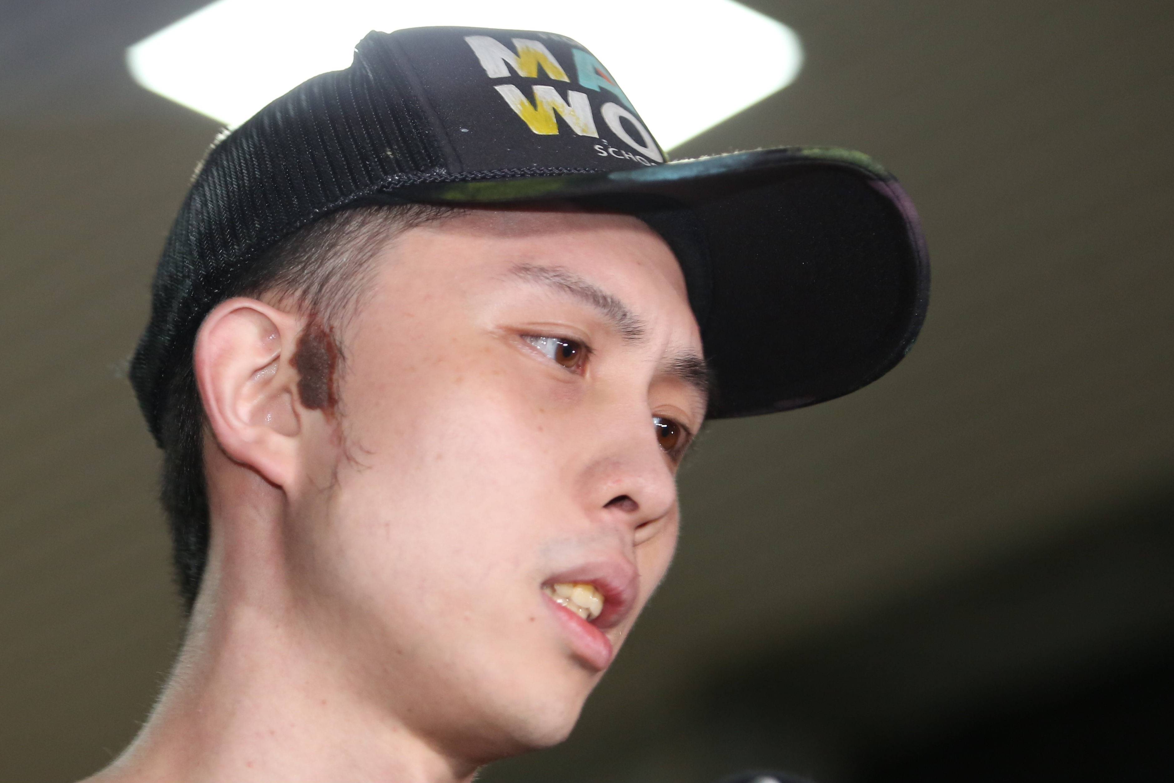 孫安佐右臉胎記一度被認為是傷痕，實際是胎記。（鏡報姜永年攝）