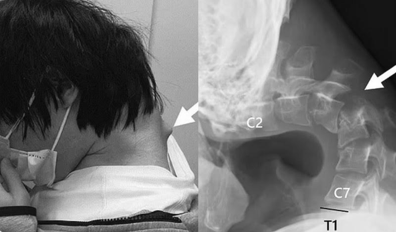 日本一名年輕男子因長期低頭玩遊戲,導致頸椎變形。(翻攝X@scharacter123)