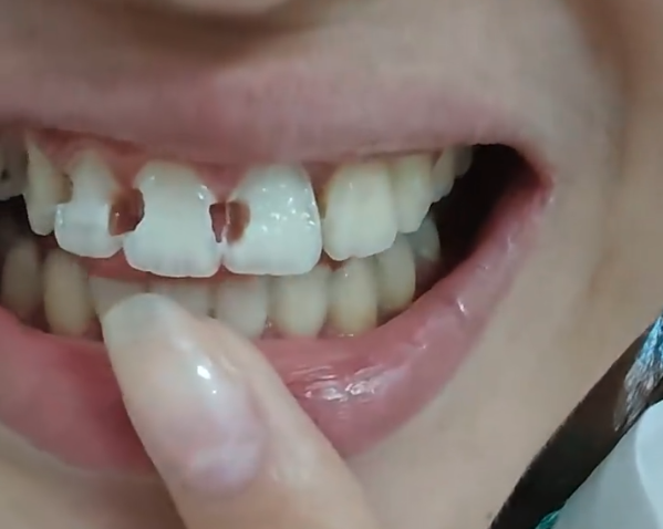 中國一名女子拆完牙套後，驚覺8顆牙齒全蛀光。（翻攝自微博）