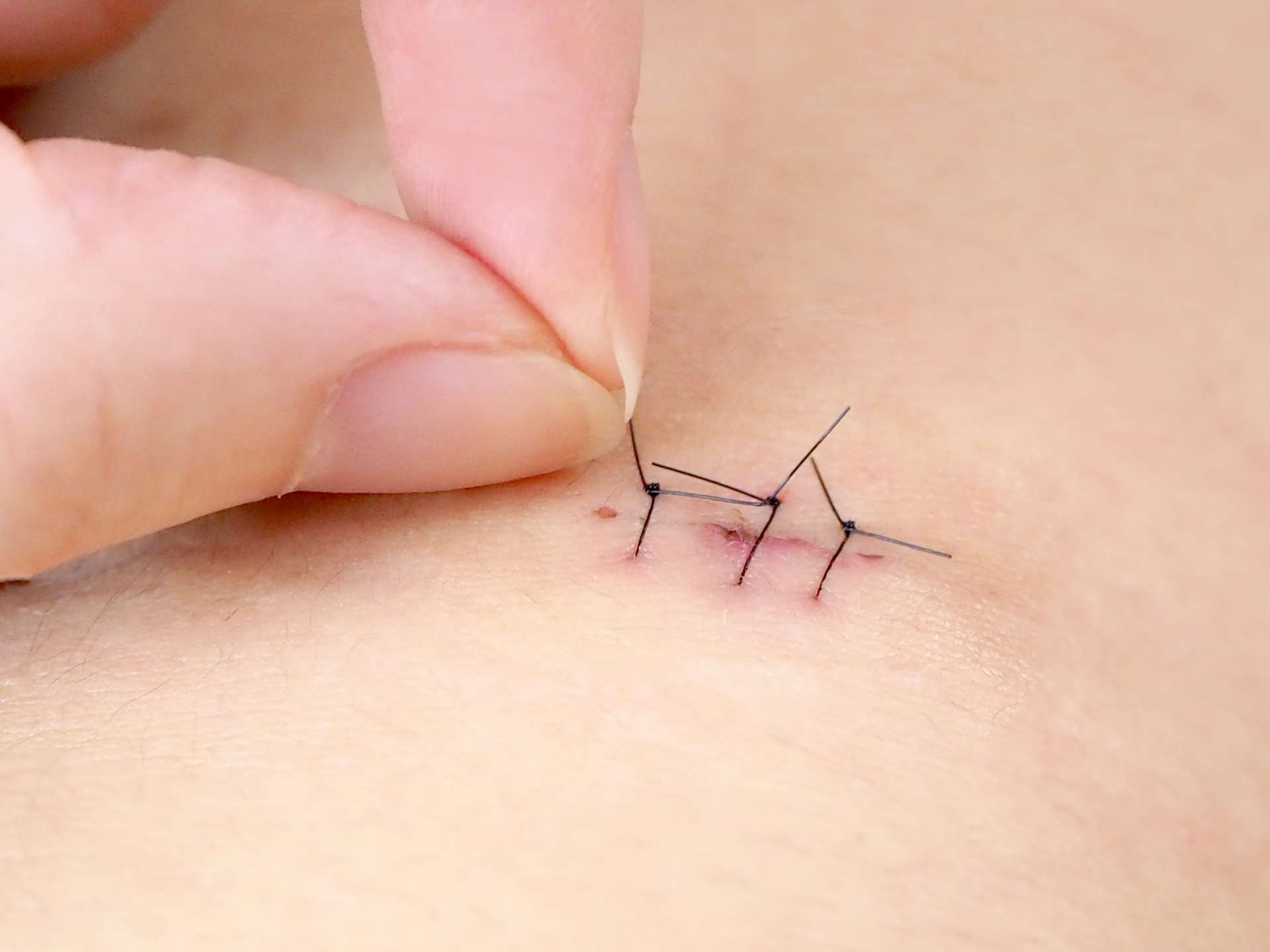 印度一名男子因腹痛難耐，居然從YouTube自學開刀，在家自行開腹手術並縫合。（示意圖，photoAC）