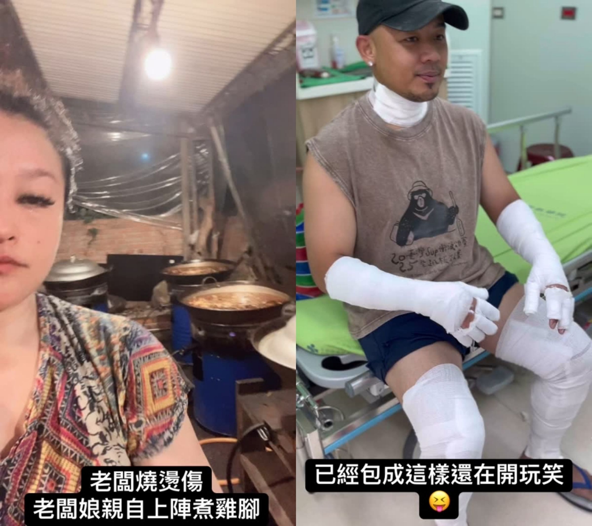 紀曉君與老公在台東開店,不慎氣爆造成老公二度燒傷。(翻攝紀曉君INS)