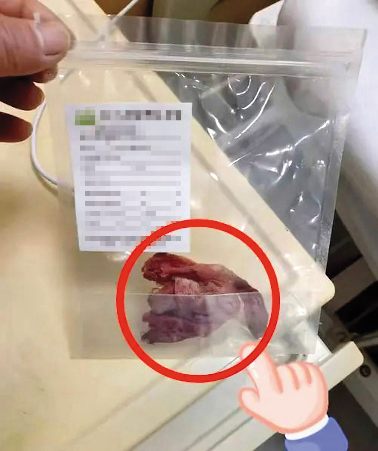 惠心診所遭控術後在產婦體內留下紗布,導致被害人1年多來疼痛不已。(示意圖,非當事人案例,翻攝微博)