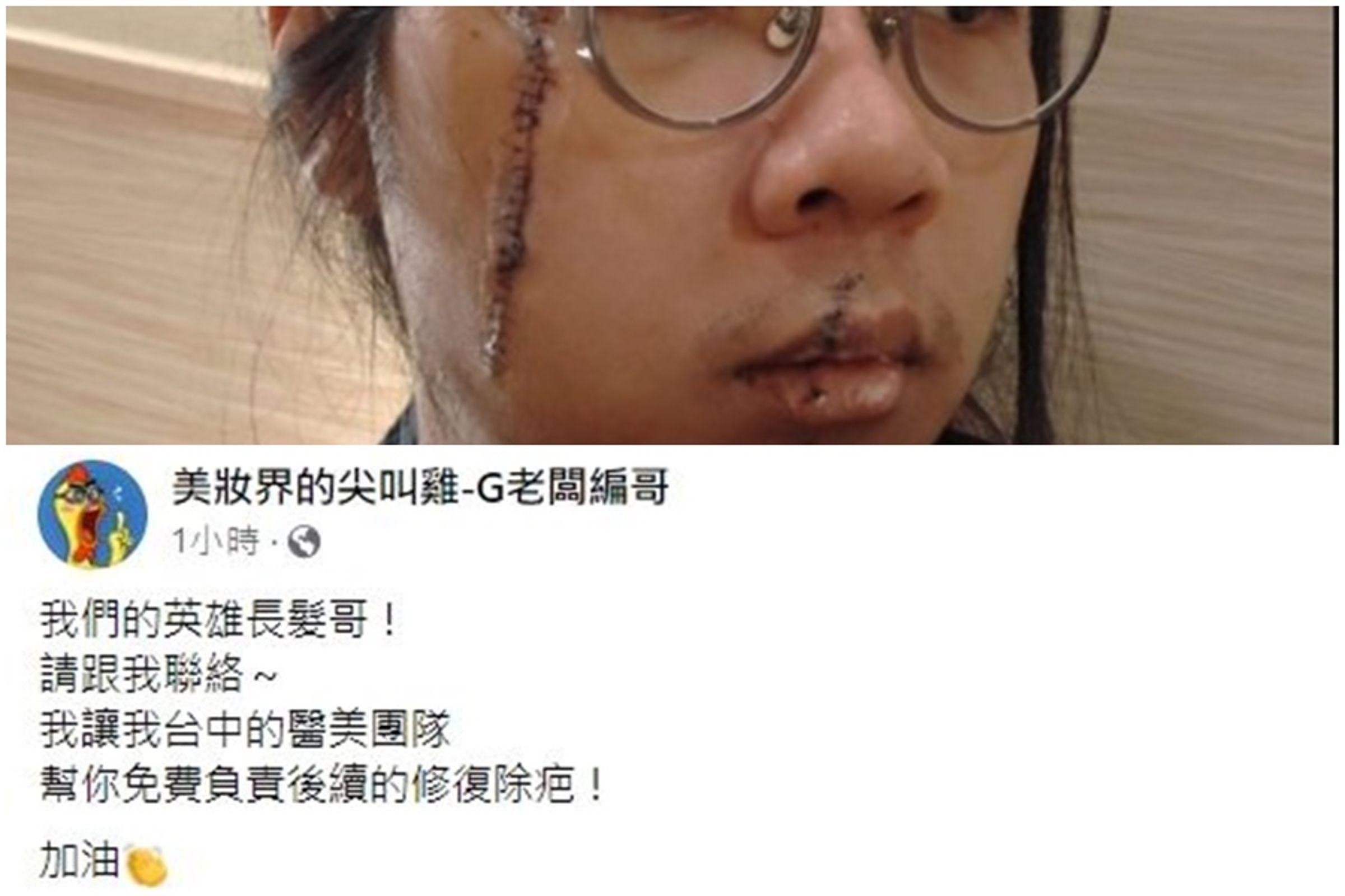27歲的「長髮哥」臉部遭洪嫌割傷嚴重,後續也會有傷疤,「美妝界的尖叫雞-G老闆編哥」表示願意免費出除疤費用。(翻攝自長髮哥IG、G老闆編哥臉書)