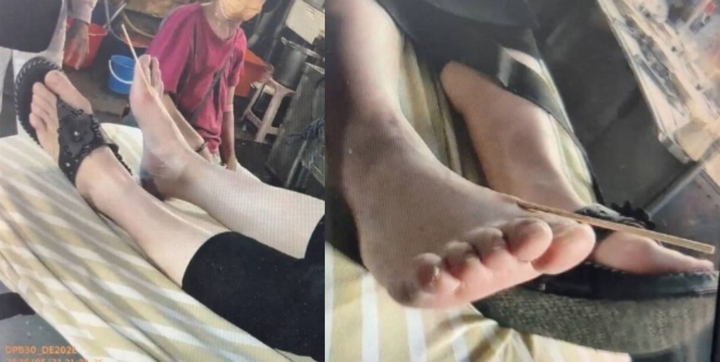 救護人員評估發現，竹籤疑似因受傷女子踩踏後翻轉，直接從上方刺入右腳腳背，現場血跡斑斑，目前已送往衛福部基隆醫院治療。（翻攝畫面）