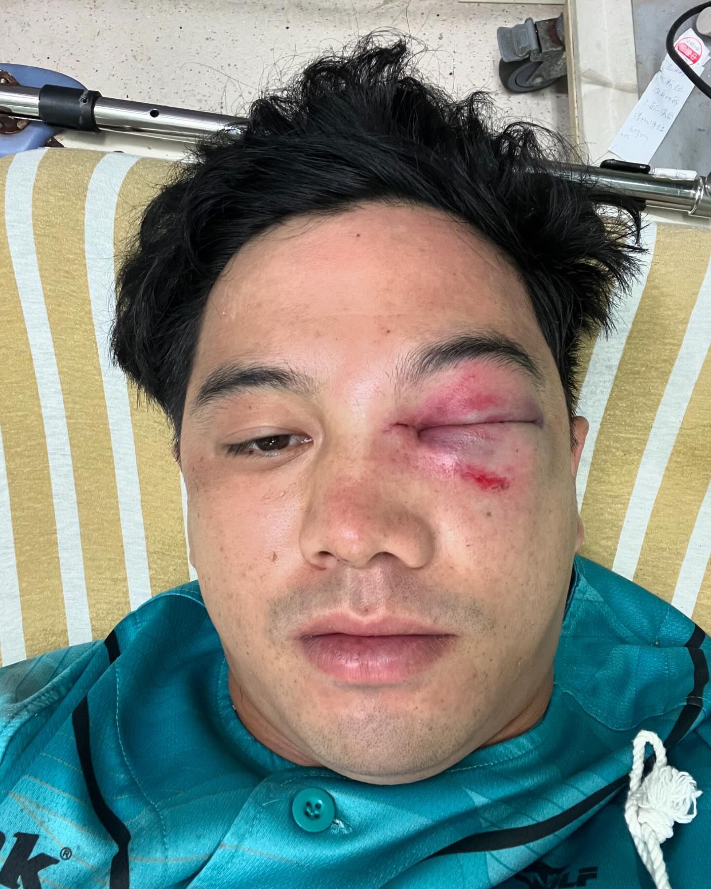 吳念庭傷勢嚴重,左眼明顯腫脹。(翻攝吳念庭臉書)
