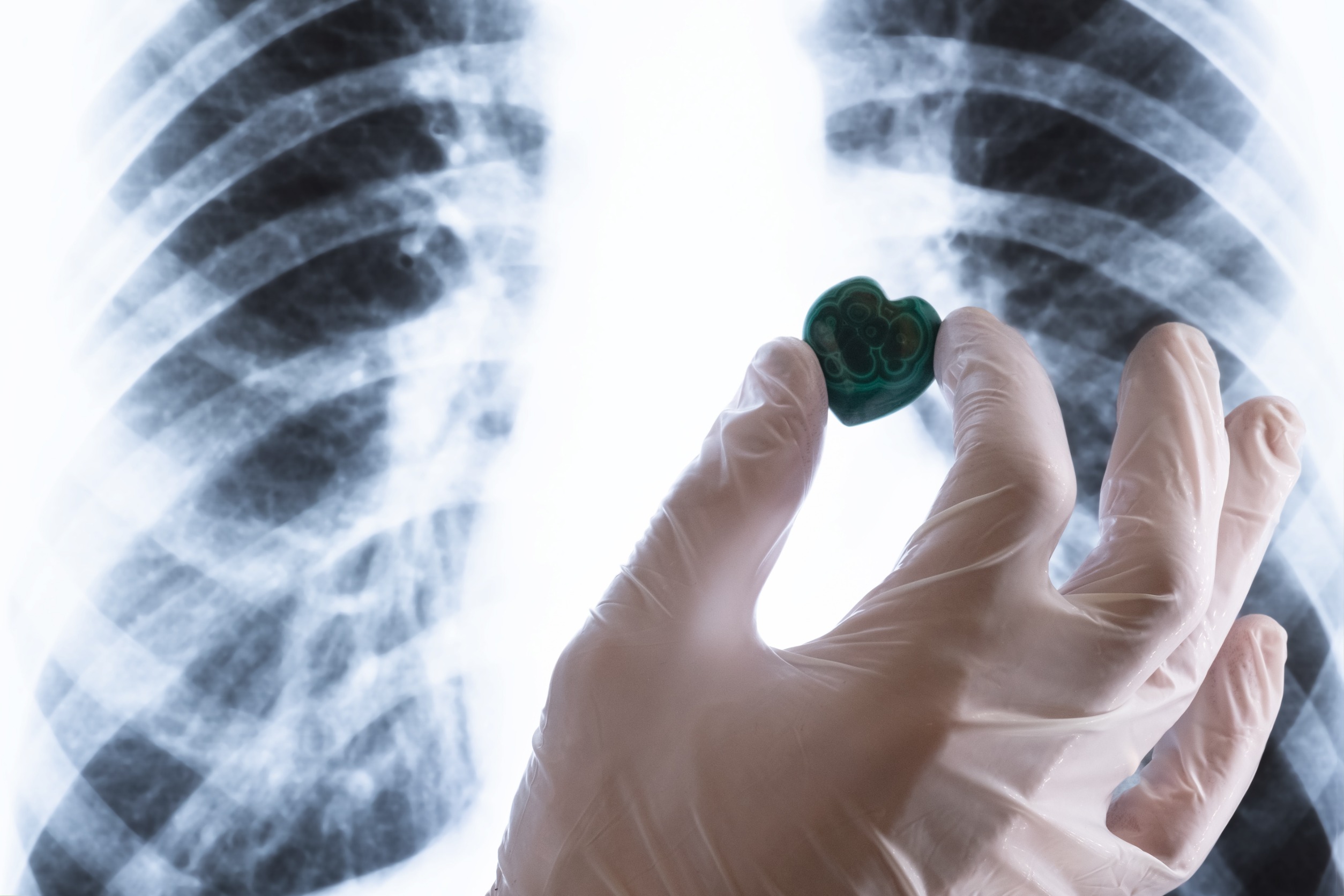 臺灣曾經為亞洲首先提供肺癌標靶藥物第一線給付的國家，2022年卻開始走回頭路，如今最新一代標靶治療在日本、新加坡及中國都已全面給付，韓國也將比照國際指引給付，臺灣應迎頭趕上。