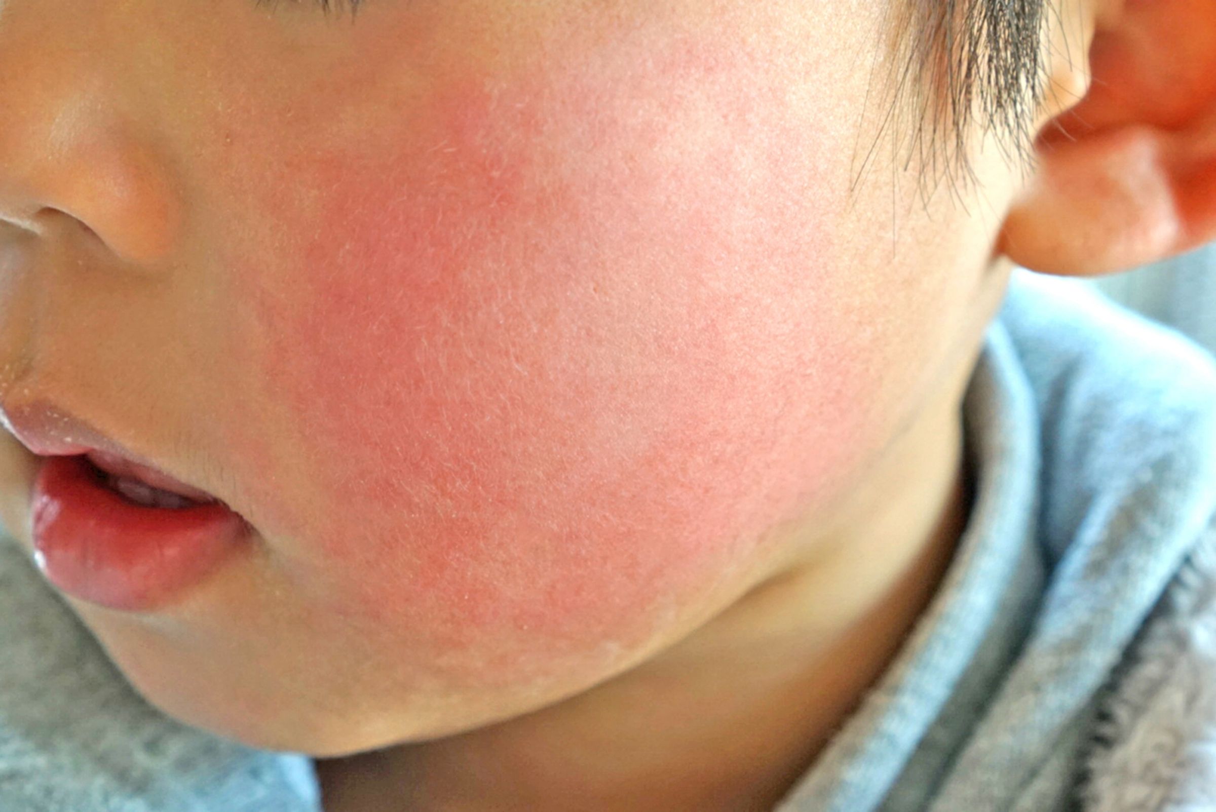 傳染性紅斑症（俗稱「蘋果病」），會導致典型的「臉頰像被打了一巴掌」的鮮紅斑疹。（翻攝自photo-ac）