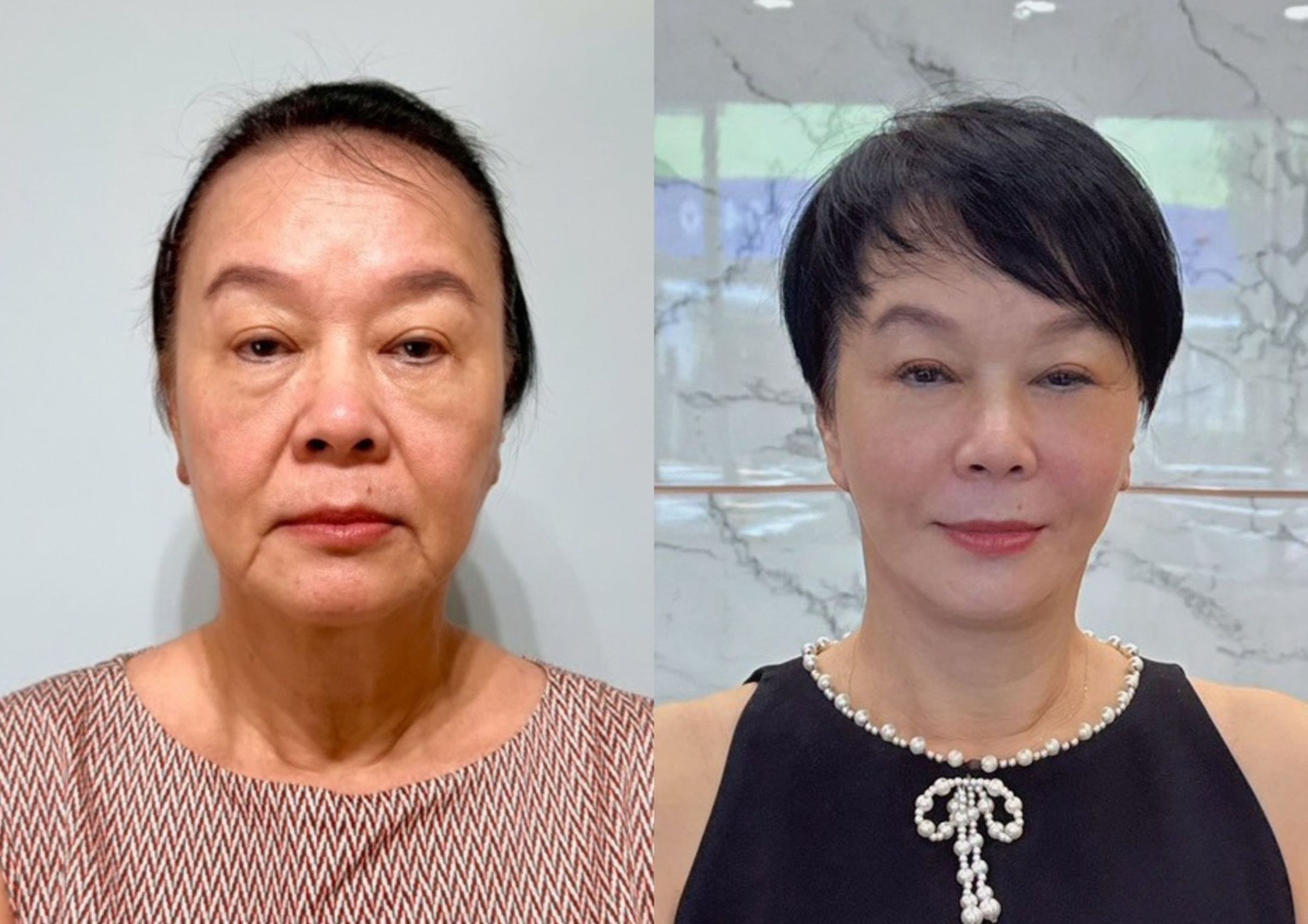 布蘭妮術前術後對比照。(陽光璨亮整型外科團隊提供)