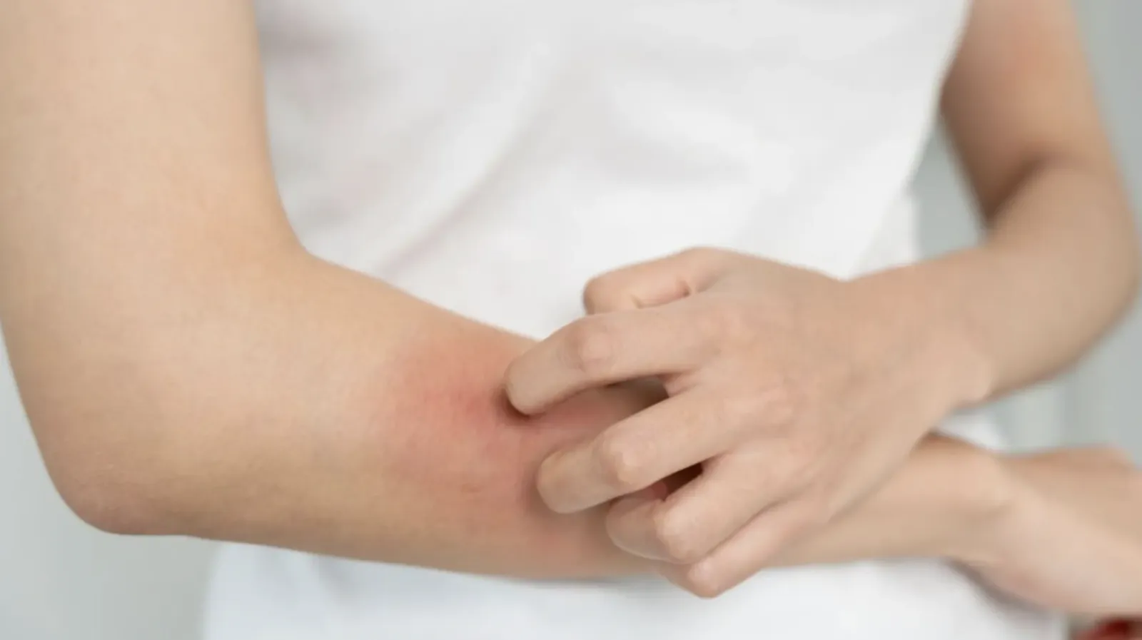 新北增1例麻疹「急匡列526人」。（示意圖，freepik）