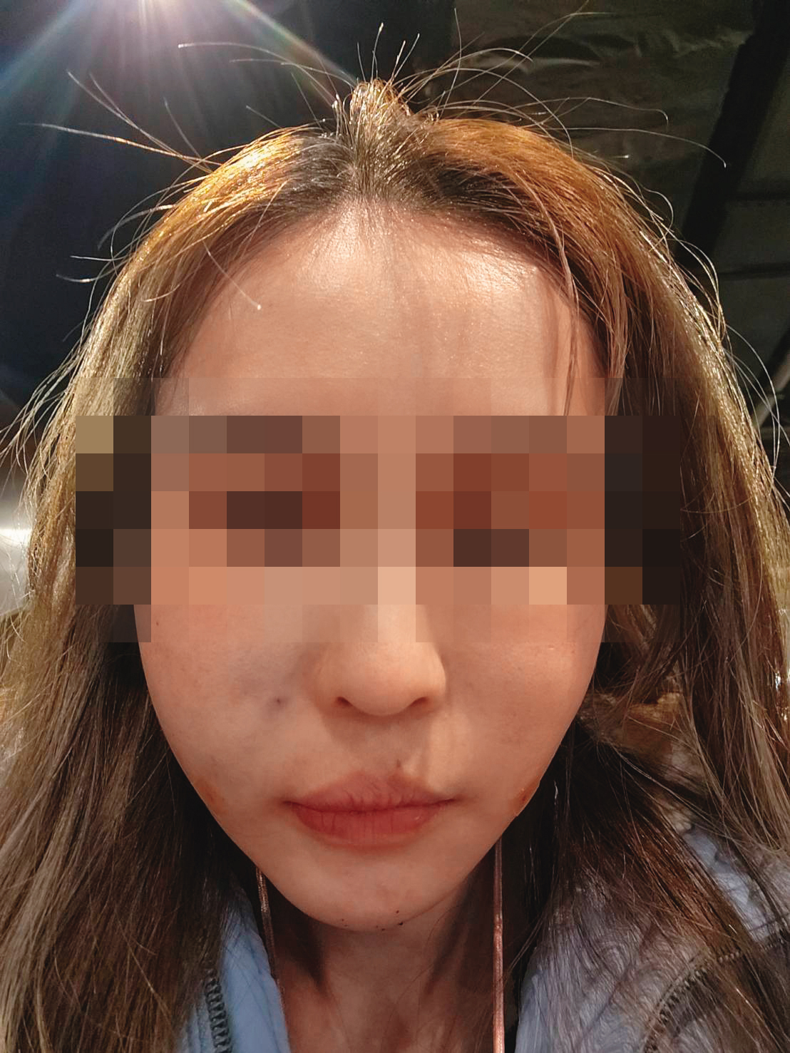 術後整張臉腫到像豬頭,讓C小姐痛不欲生。(讀者提供)