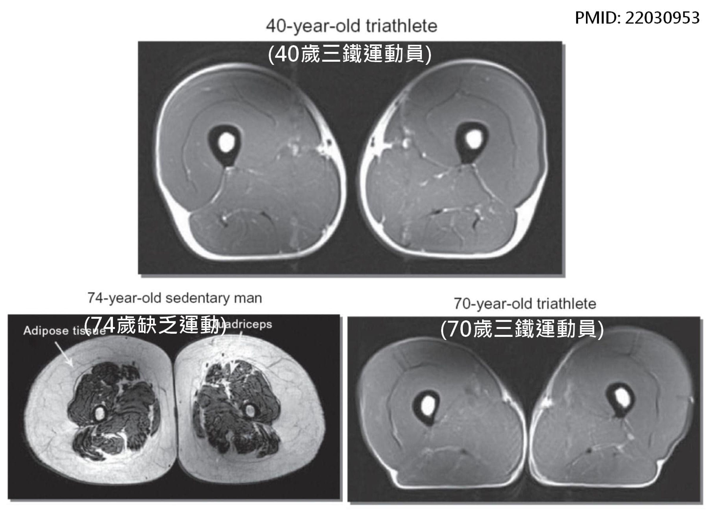 一名醫師在臉書分享有無運動的民眾磁振造影對比圖，掀起熱議。（翻攝臉書「蔡明劼醫師 健康。瘦身」）