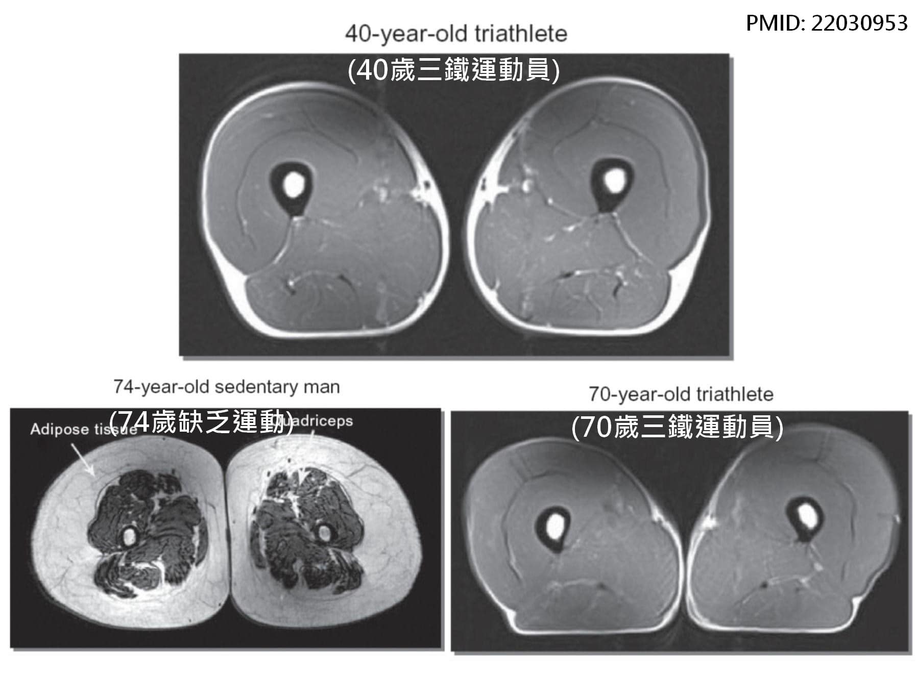 一名醫師在臉書分享有無運動的民眾磁振造影對比圖，掀起熱議。（翻攝臉書「蔡明劼醫師 健康。瘦身」）