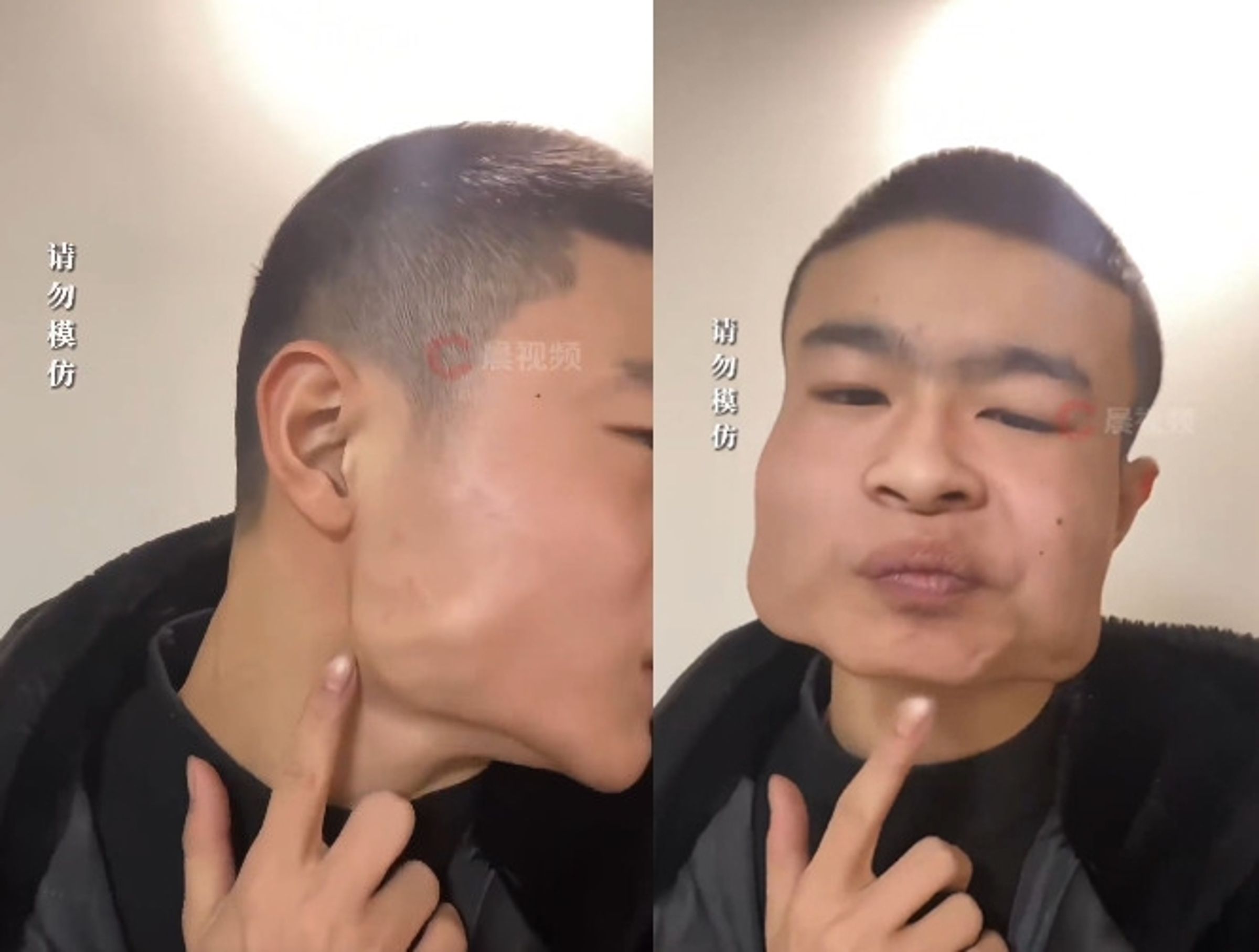 中國一名青少年因長期吃檳榔,導致臉變成方塊臉。(翻攝微博)