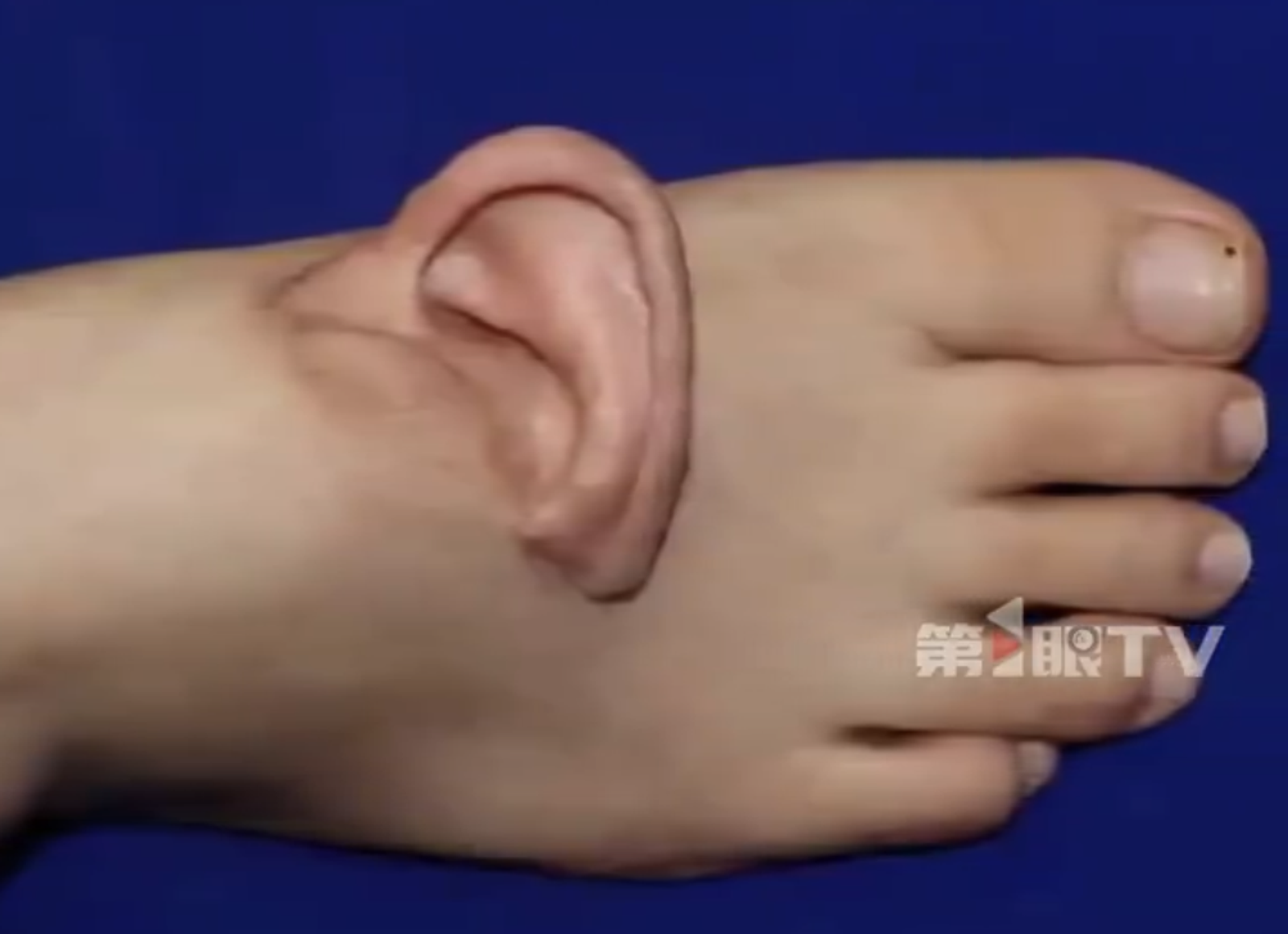 中國女遭機器扯走整片頭皮! 醫師把耳朵「寄養腳背」5個月後成功移回原位