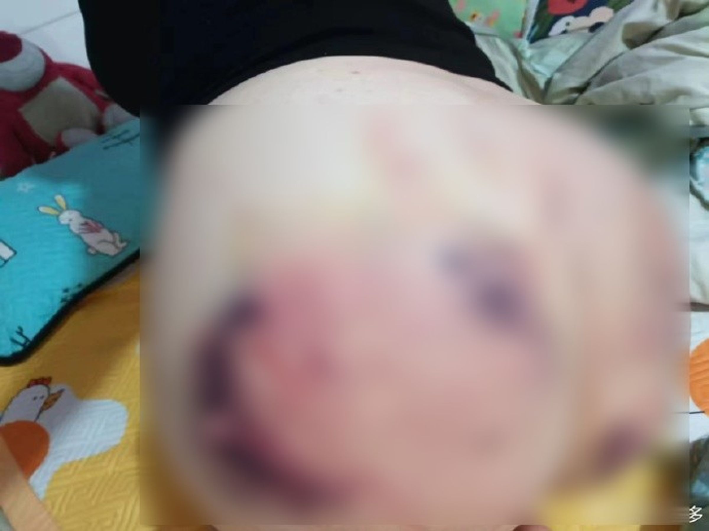 正妹的臀部,滿是傷痕。(翻自微博)