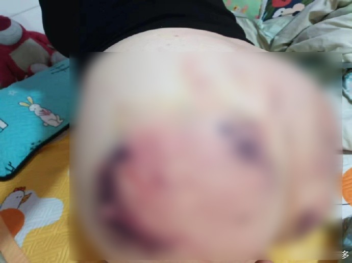 正妹的臀部,滿是傷痕。(翻自微博)