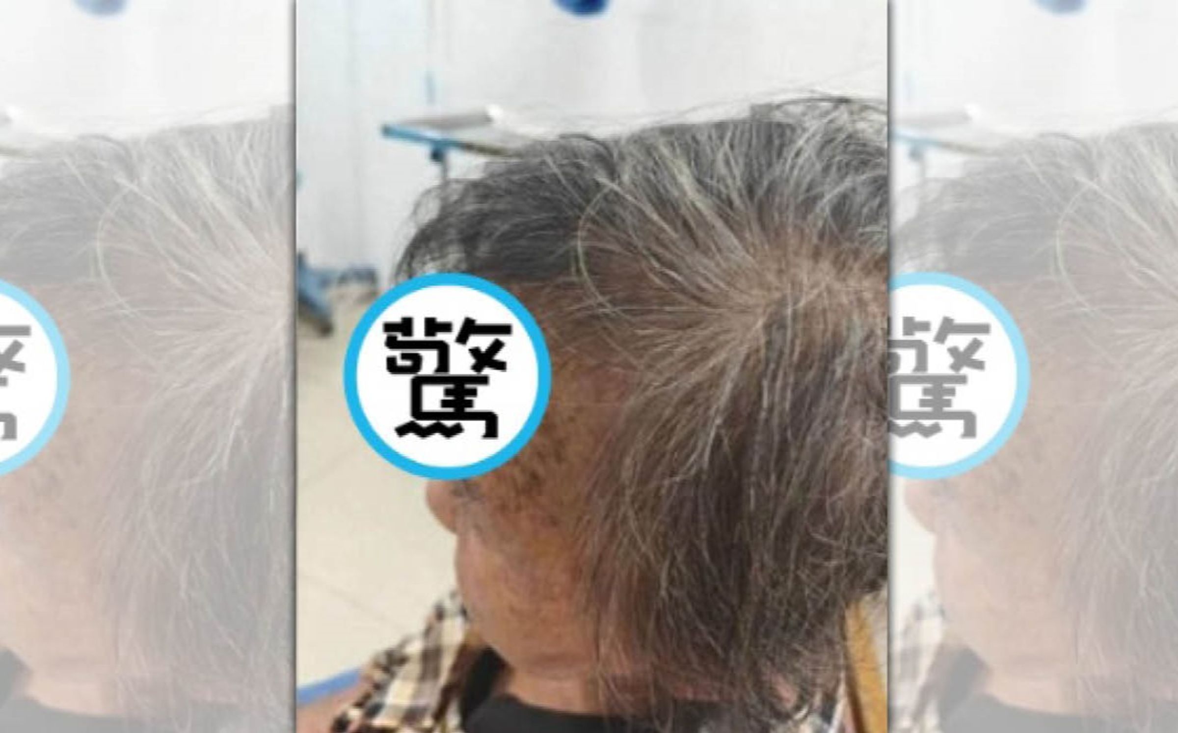 上海驚現「長角奶奶」！額頭贅生物竟自行動手剪斷。（翻攝自環球網資訊）