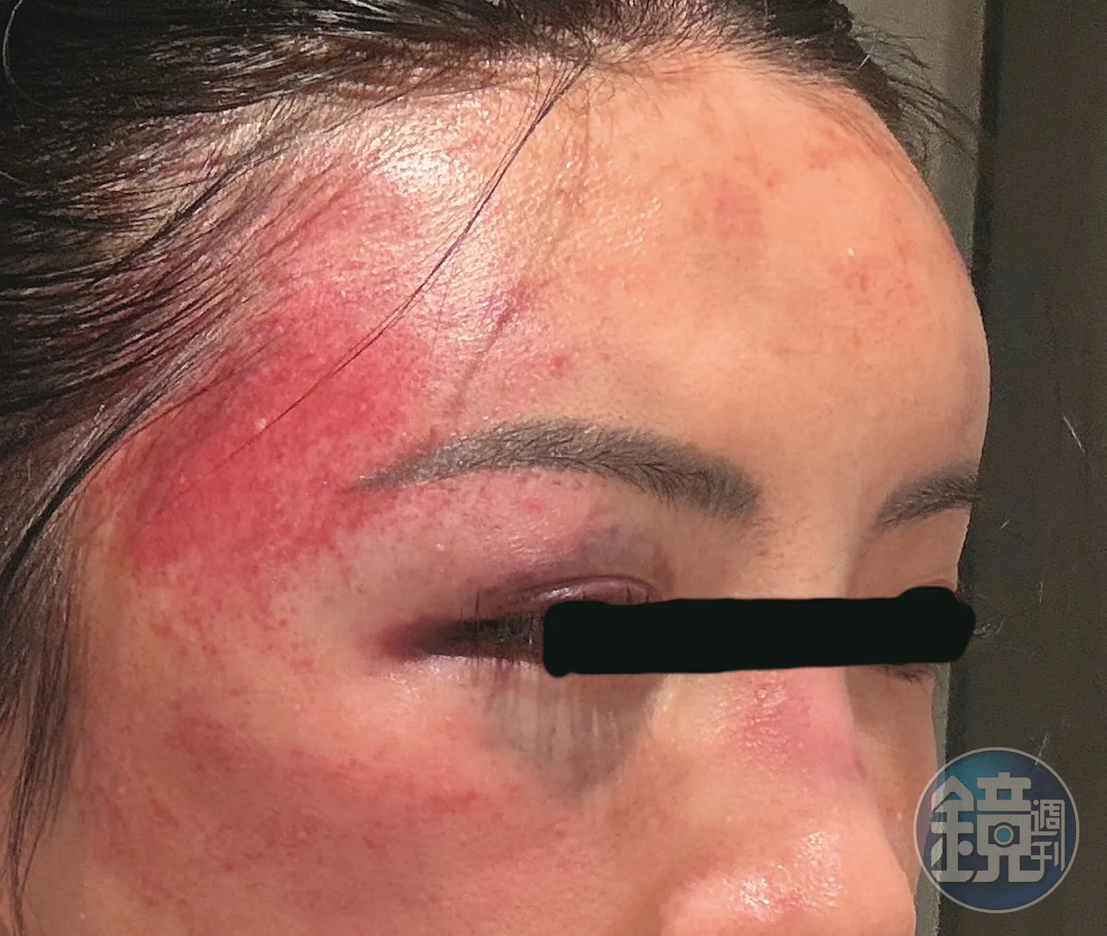 華人調酒大師許可宗家暴女友，導致女方臉部多處瘀青。資料照