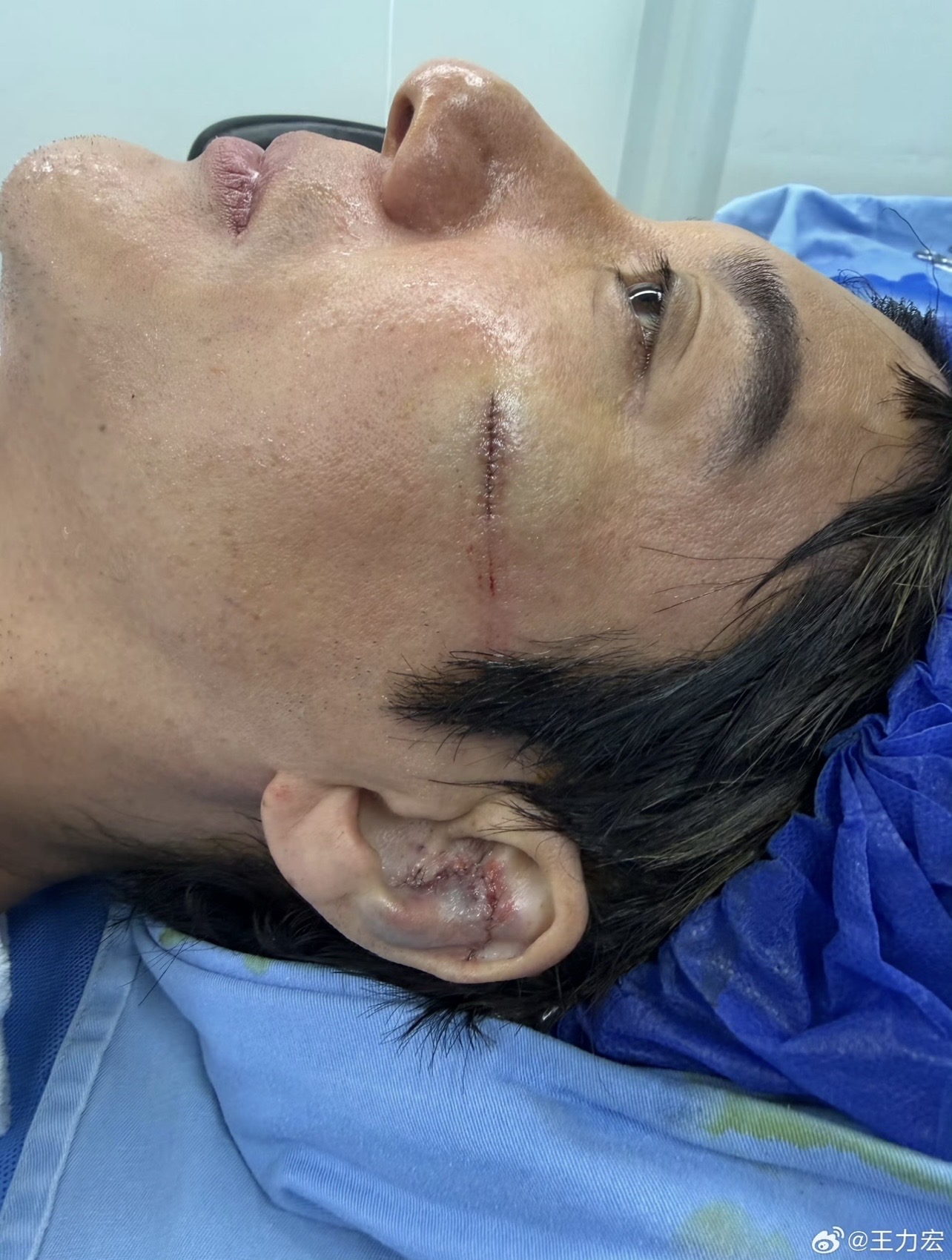 舞台重摔後,王力宏赴醫院接受傷口縫合。(圖/翻攝自王力宏微博)
