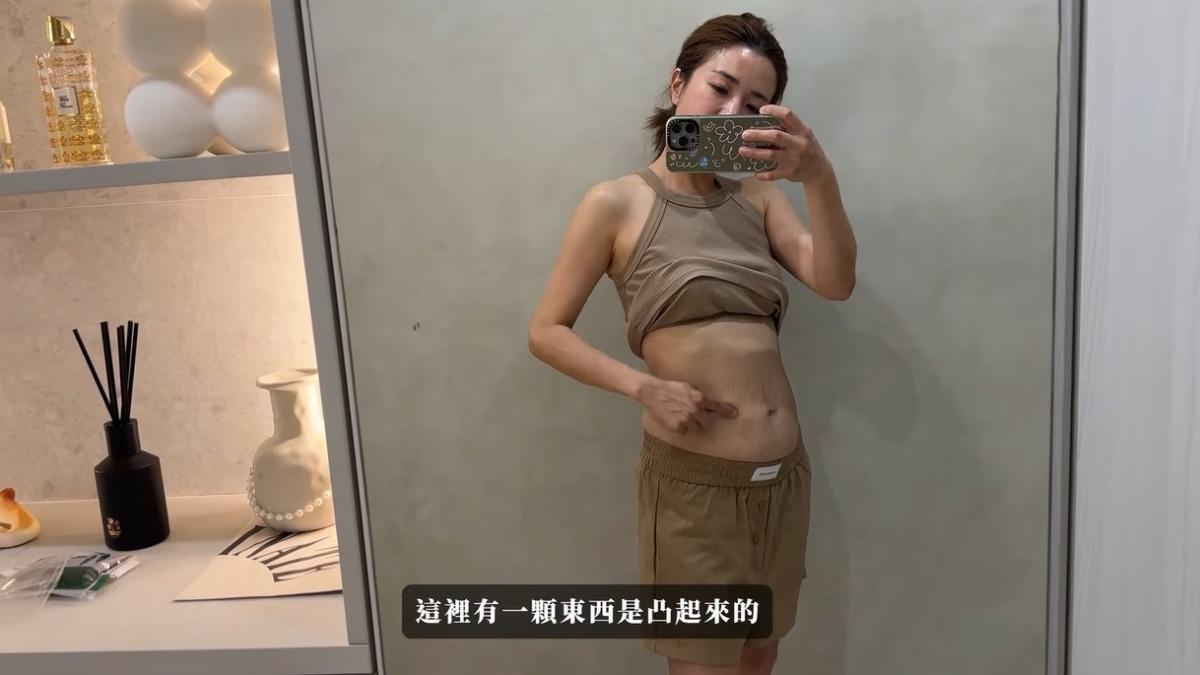 江老師下腹部腫大，一度以為是變胖，結果竟然是腫瘤。（翻攝自「我是江老師」YouTube）