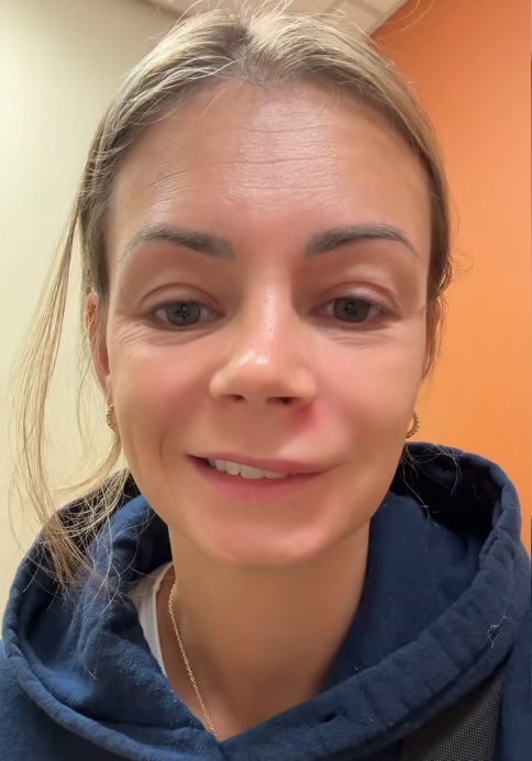 美國三寶媽因擠鼻下痘，4小時臉腫變形送急診，微笑時半邊臉無法動彈。（翻攝TikTok @lishmarie1）