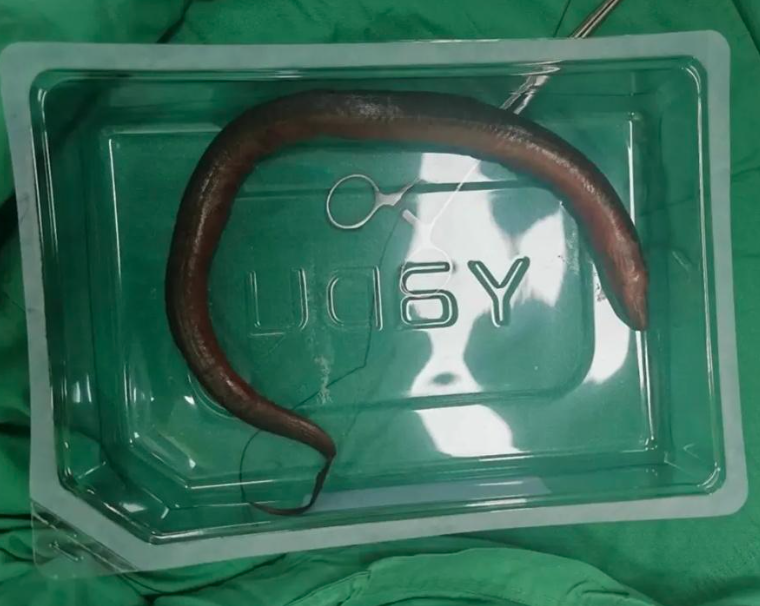 一條長達30公分的活鱔魚，從肛門鑽進男子的腸道。（翻攝自微博）