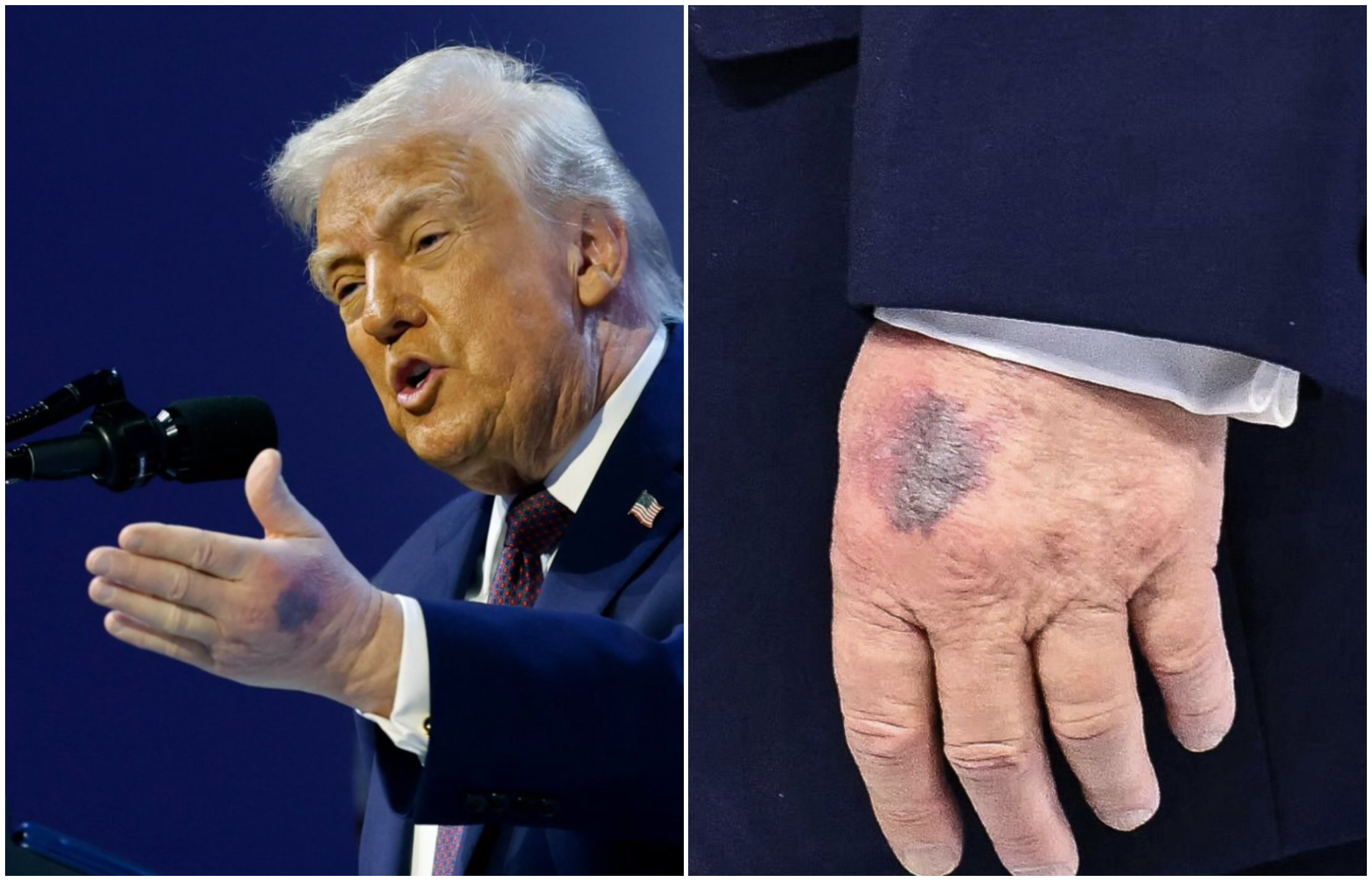 川普左手背又冒大片瘀青！白宮這回這樣解釋　79歲健康狀況再引關注