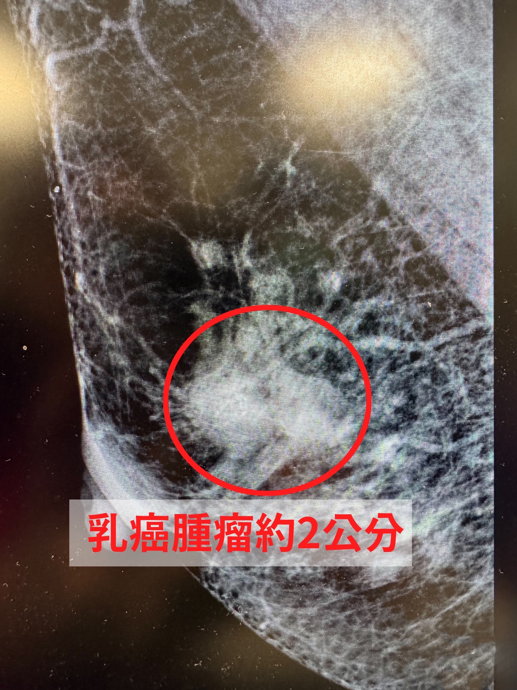 病患經乳房超音波檢查，發現乳頭下方合併有2個邊緣不規則、部分模糊的腫瘤病灶，確診乳癌第2期。（中國醫藥大學新竹附設醫院提供）