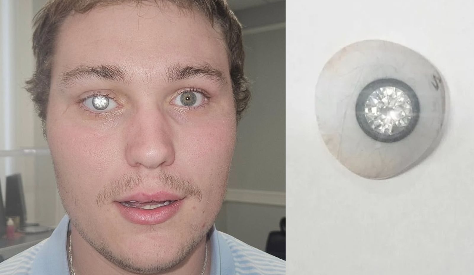 007反派來了?珠寶師6千萬義眼「鑲2克拉鑽石」 網友怕他被活摘器官