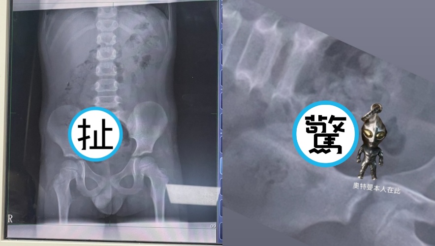 宜蘭一名7歲男童誤吞吊飾，X光一照發現該吊飾完整出現在腸道裡。（翻攝自threads@shia.iii）
