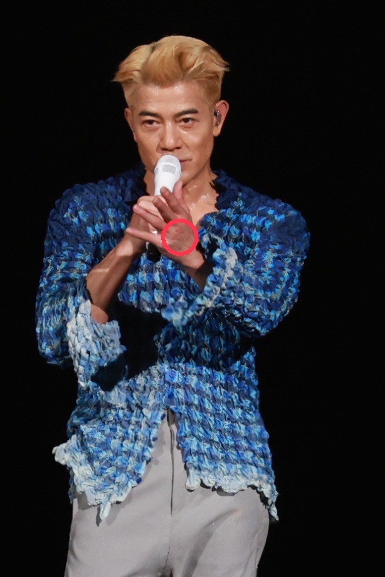 郭富城舞蹈動作太大，左手意外濺血。